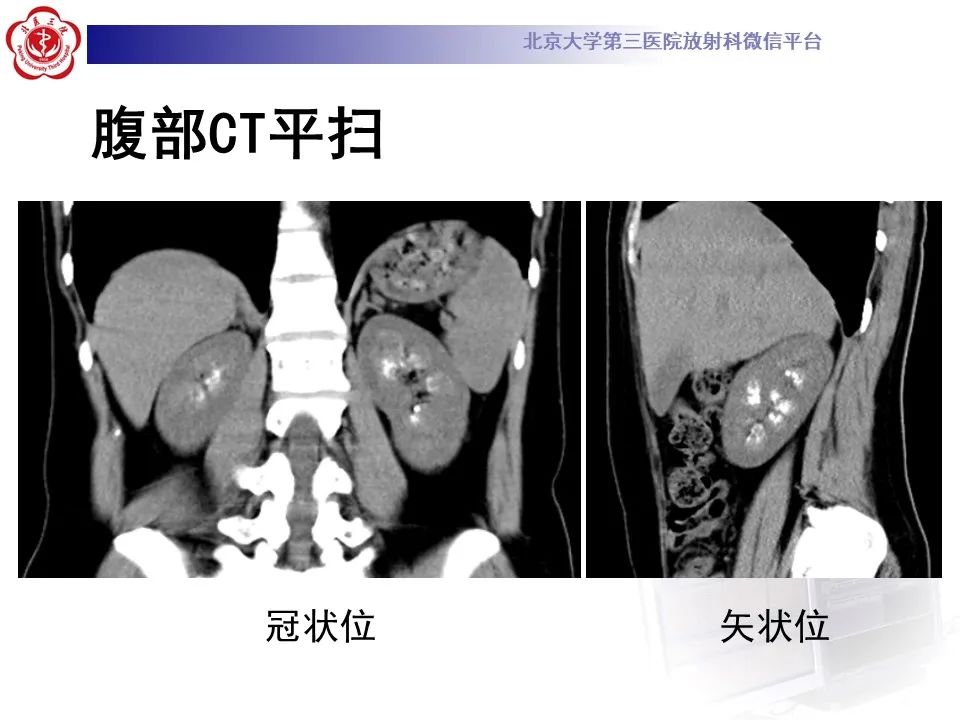 影像PPT - 【PPT】髓质海绵肾的影像-5