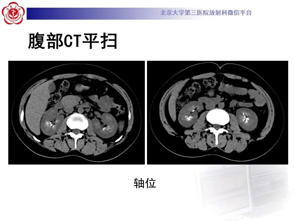 影像PPT - 【PPT】髓质海绵肾的影像-4