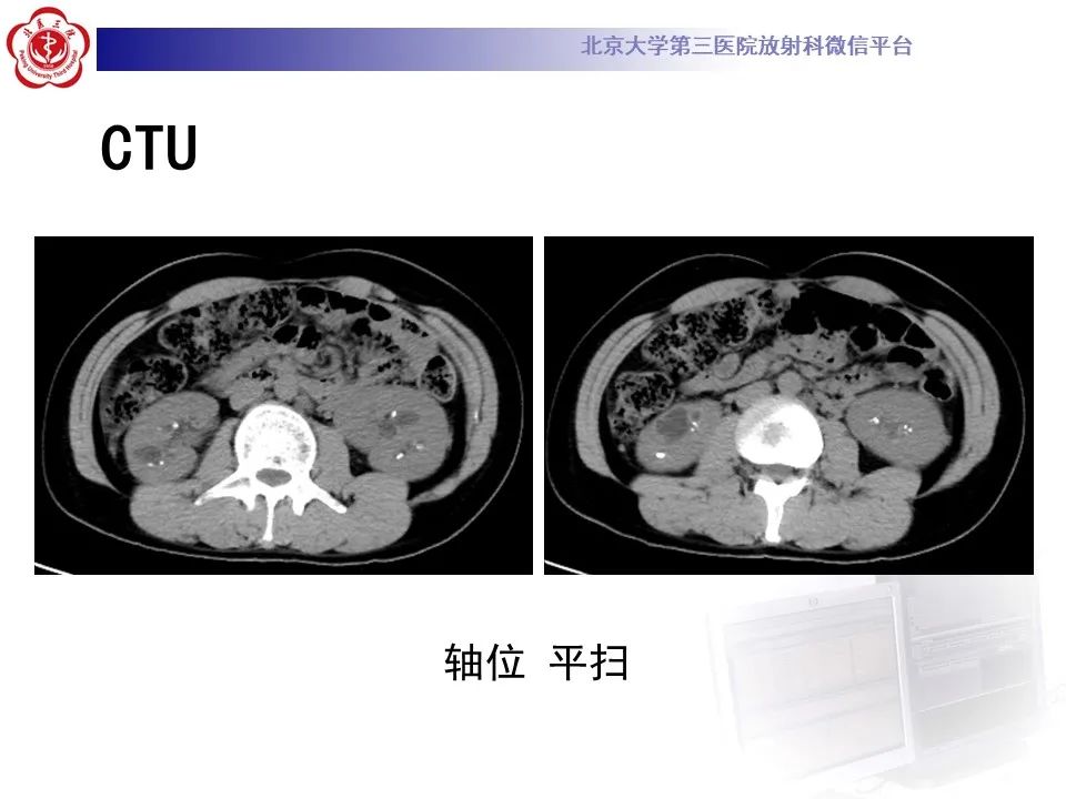 影像PPT - 【PPT】髓质海绵肾的影像-9