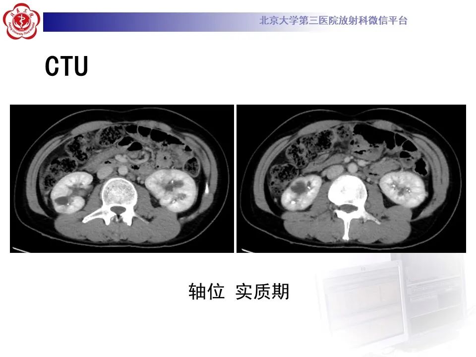 影像PPT - 【PPT】髓质海绵肾的影像-10