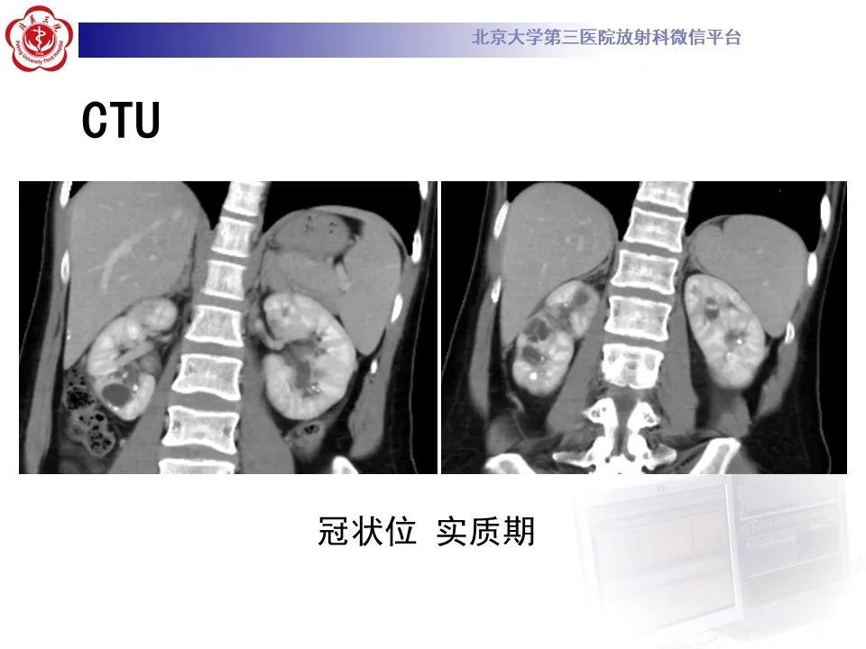 影像PPT - 【PPT】髓质海绵肾的影像-11