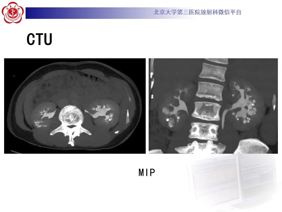 影像PPT - 【PPT】髓质海绵肾的影像-13