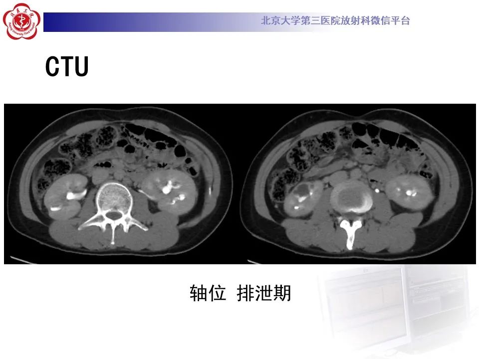 影像PPT - 【PPT】髓质海绵肾的影像-12