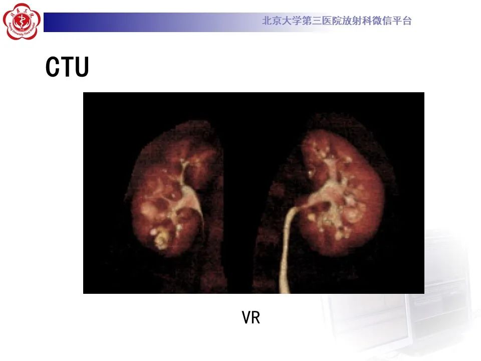 影像PPT - 【PPT】髓质海绵肾的影像-14