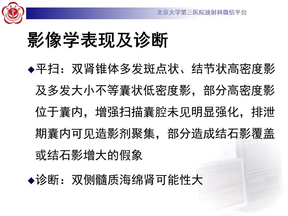 影像PPT - 【PPT】髓质海绵肾的影像-15