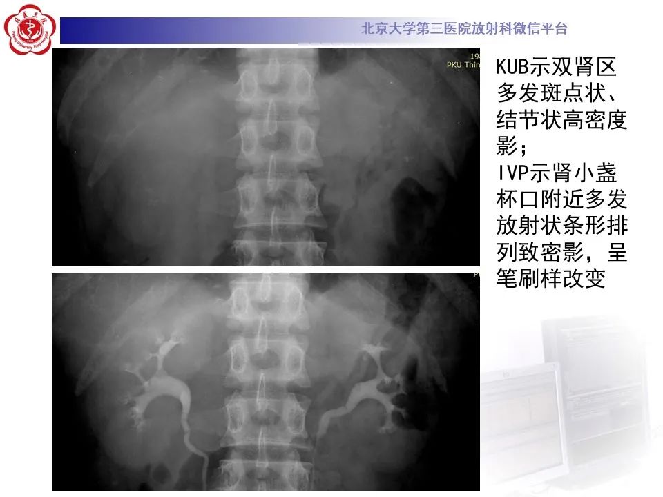 影像PPT - 【PPT】髓质海绵肾的影像-28