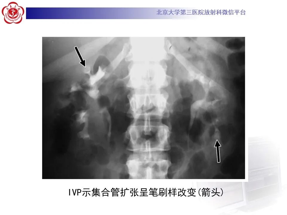 影像PPT - 【PPT】髓质海绵肾的影像-27