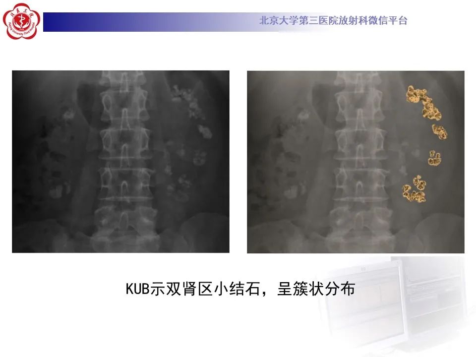 影像PPT - 【PPT】髓质海绵肾的影像-25