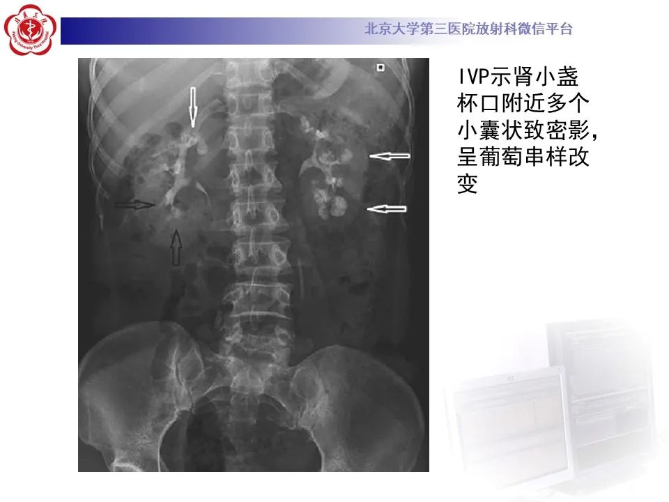 影像PPT - 【PPT】髓质海绵肾的影像-29