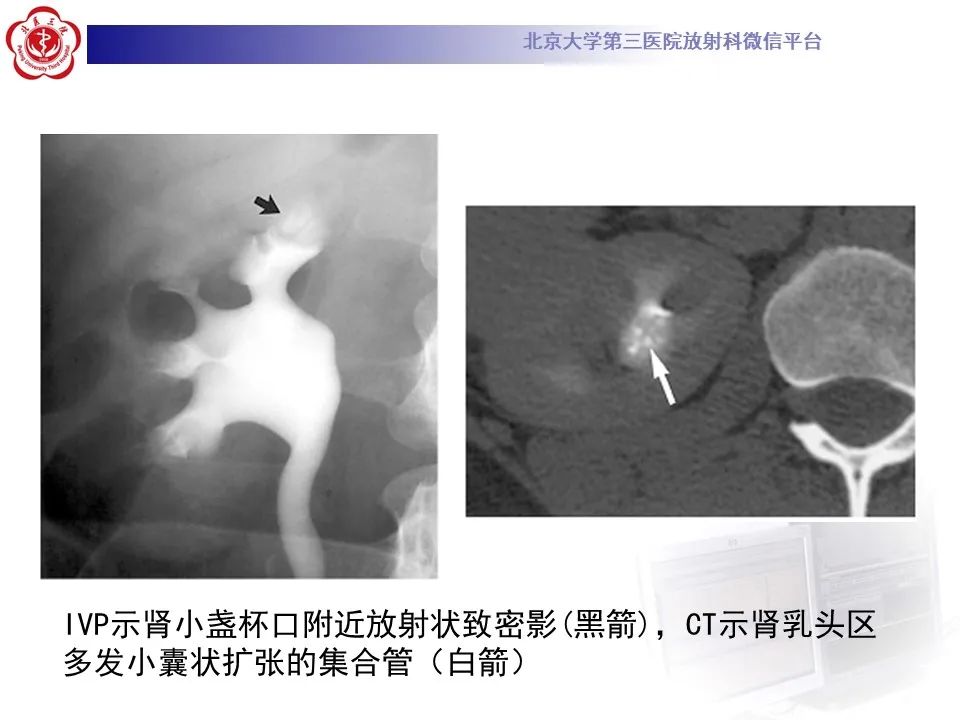 影像PPT - 【PPT】髓质海绵肾的影像-32