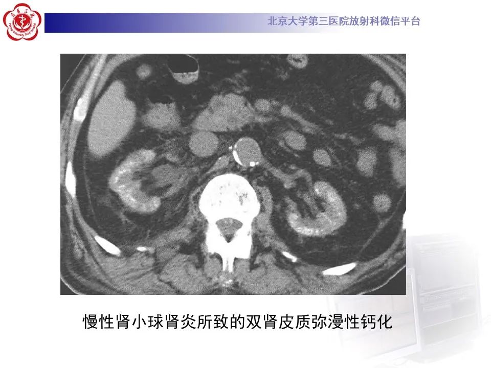 影像PPT - 【PPT】髓质海绵肾的影像-36
