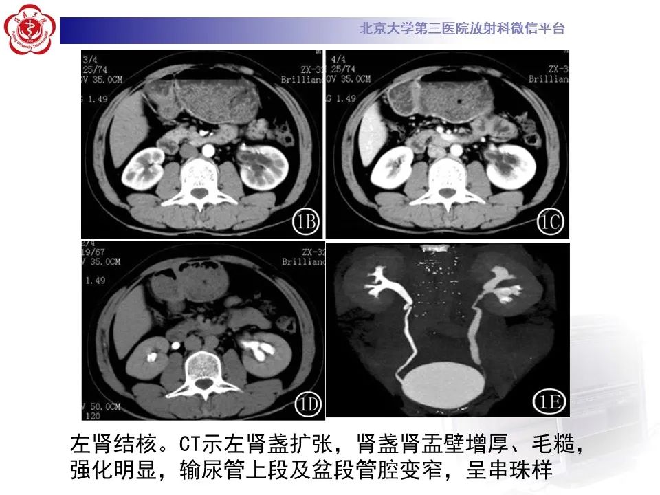 影像PPT - 【PPT】髓质海绵肾的影像-38