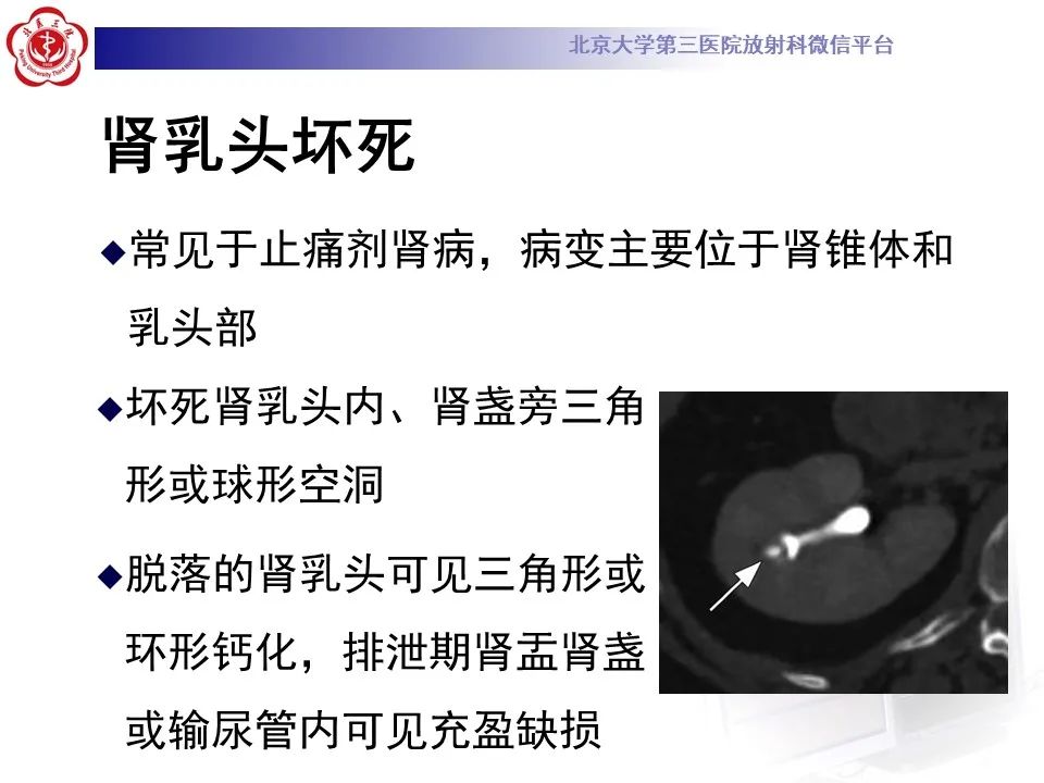 影像PPT - 【PPT】髓质海绵肾的影像-39