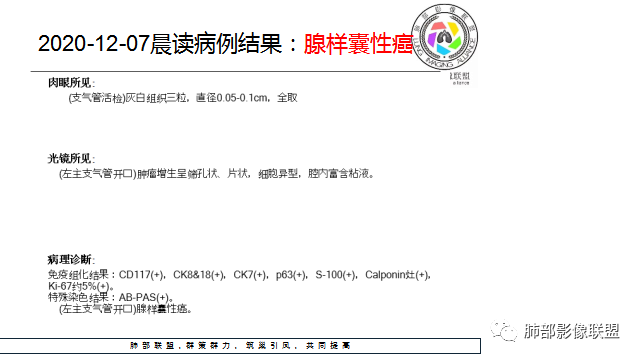 影像PPT - 【病例】支气管腺样囊性癌1例CT影像-23 影像PPT - 【病例】支气管腺样囊性癌1例CT影像-23