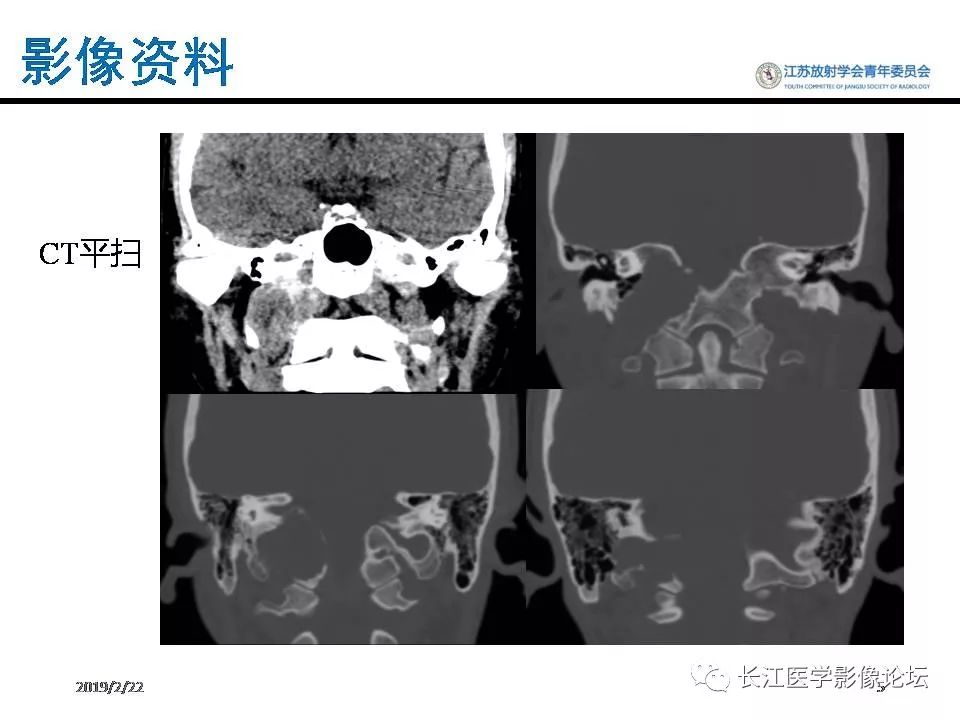 影像PPT - 【病例】颈静脉孔区神经鞘瘤1例CT及MR影像-4
