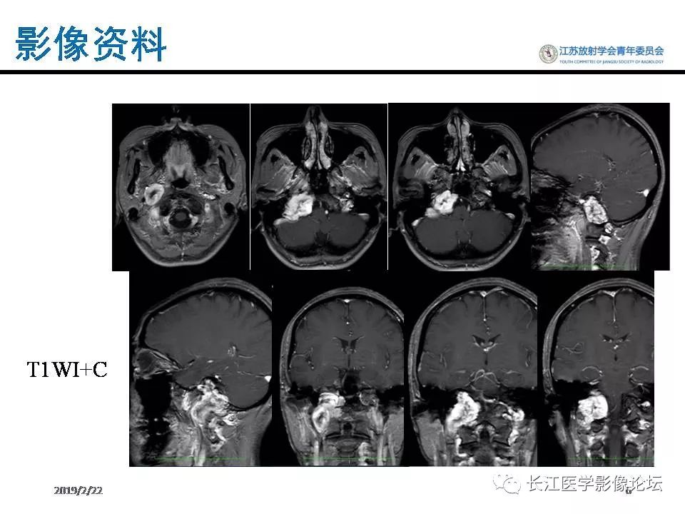 影像PPT - 【病例】颈静脉孔区神经鞘瘤1例CT及MR影像-5