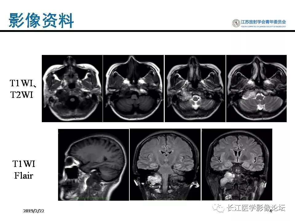 影像PPT - 【病例】颈静脉孔区神经鞘瘤1例CT及MR影像-3