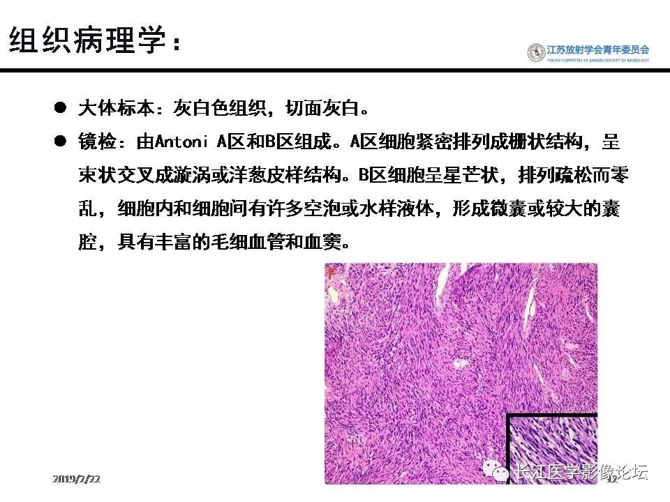 影像PPT - 【病例】颈静脉孔区神经鞘瘤1例CT及MR影像-11