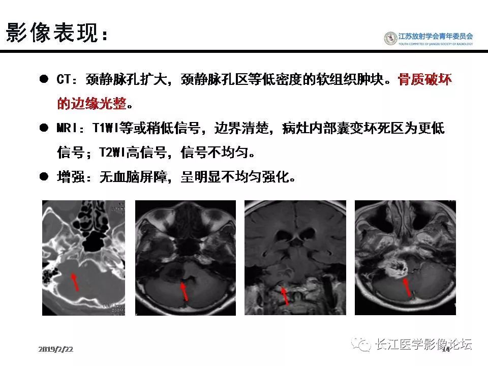 影像PPT - 【病例】颈静脉孔区神经鞘瘤1例CT及MR影像-13