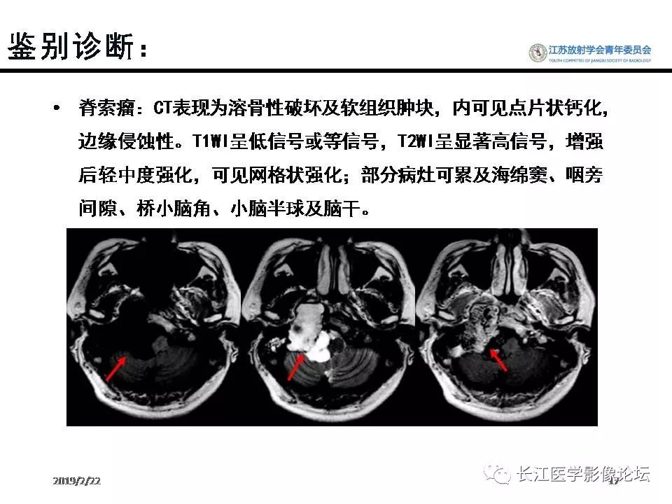 影像PPT - 【病例】颈静脉孔区神经鞘瘤1例CT及MR影像-16