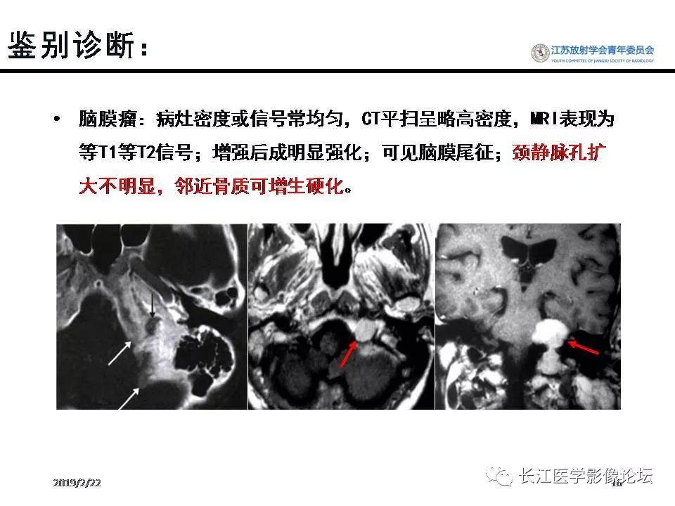 影像PPT - 【病例】颈静脉孔区神经鞘瘤1例CT及MR影像-15