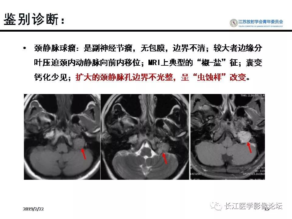 影像PPT - 【病例】颈静脉孔区神经鞘瘤1例CT及MR影像-14