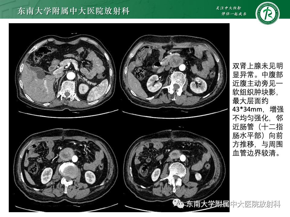 影像PPT - 【PPT】副神经节瘤的影像-2