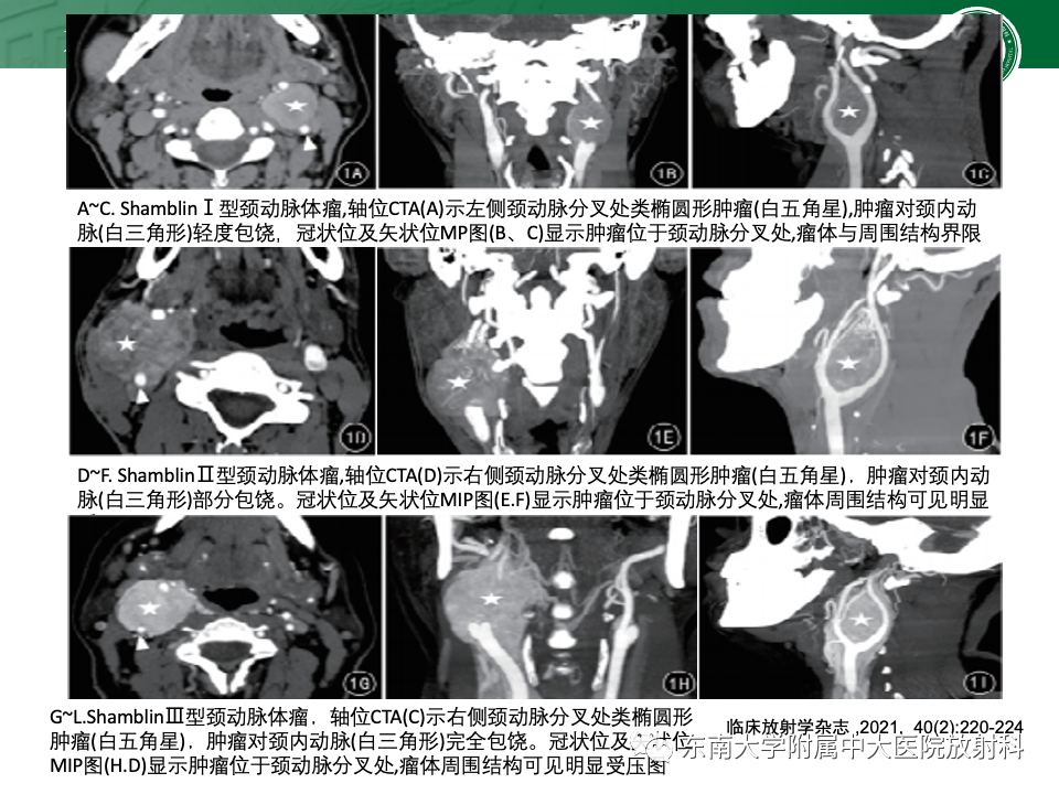 影像PPT - 【PPT】副神经节瘤的影像-21
