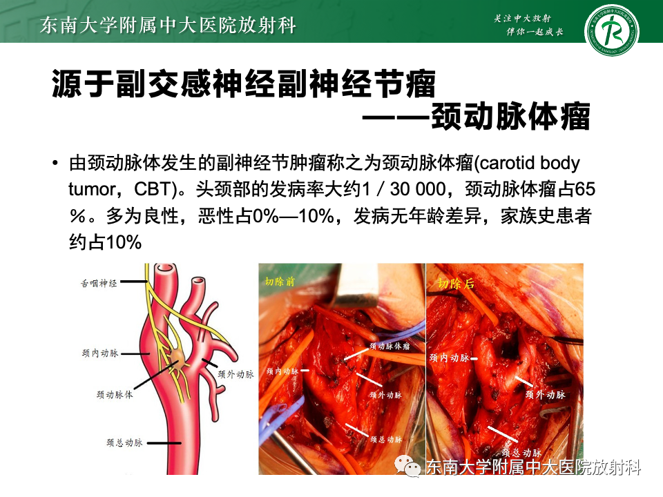 影像PPT - 【PPT】副神经节瘤的影像-17
