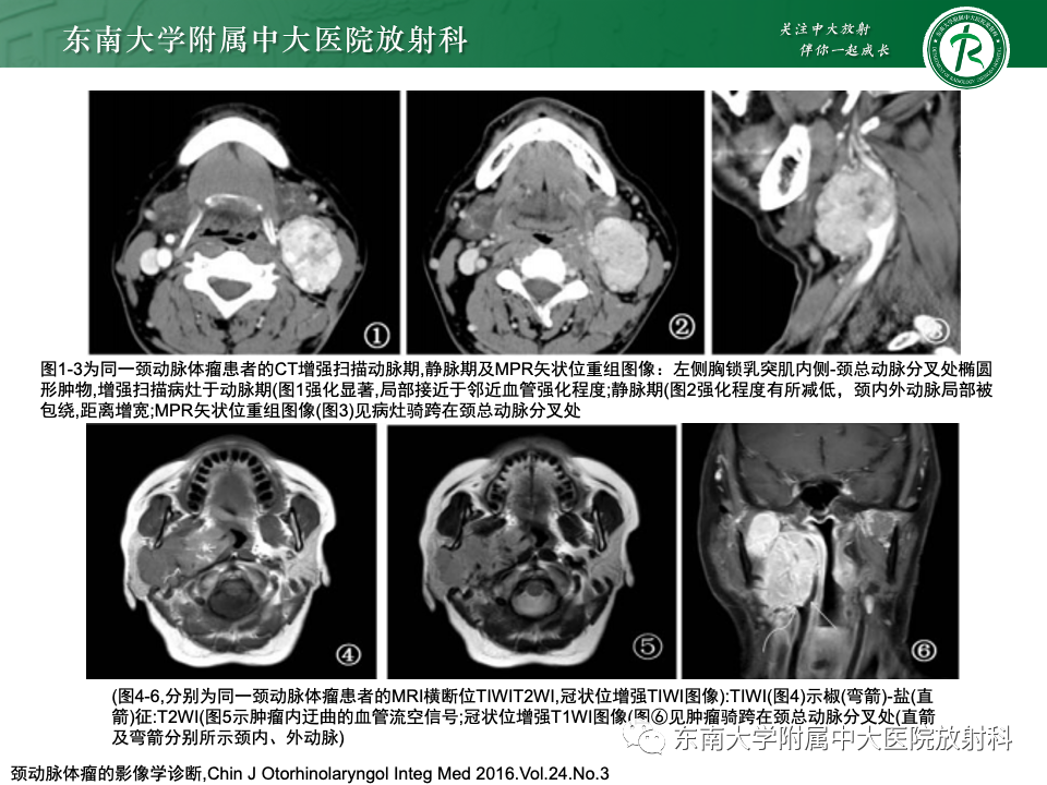 影像PPT - 【PPT】副神经节瘤的影像-24