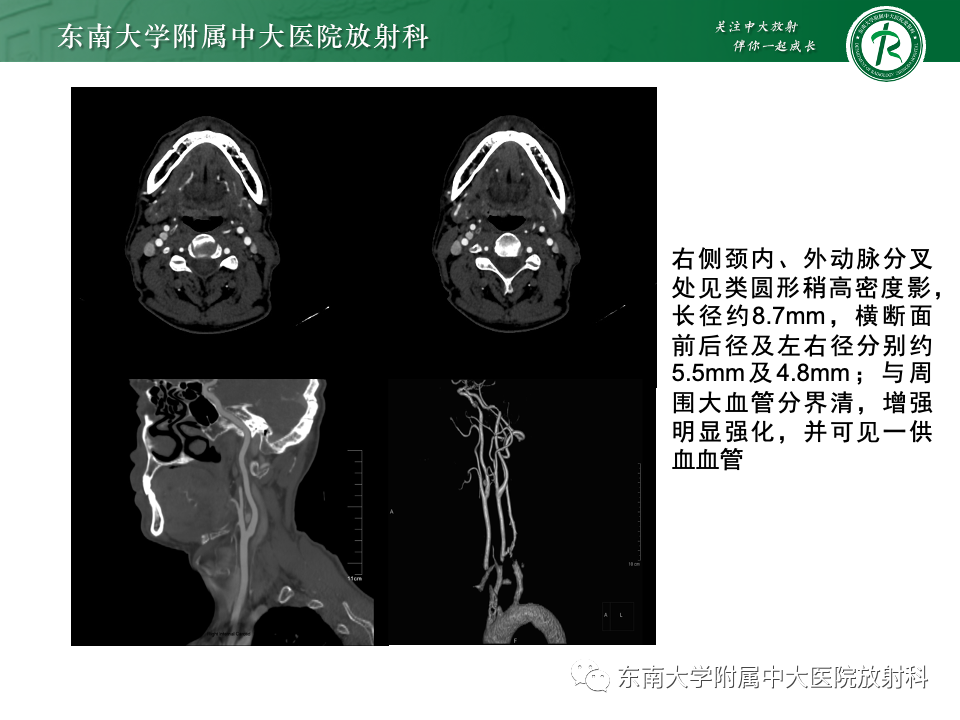 影像PPT - 【PPT】副神经节瘤的影像-26