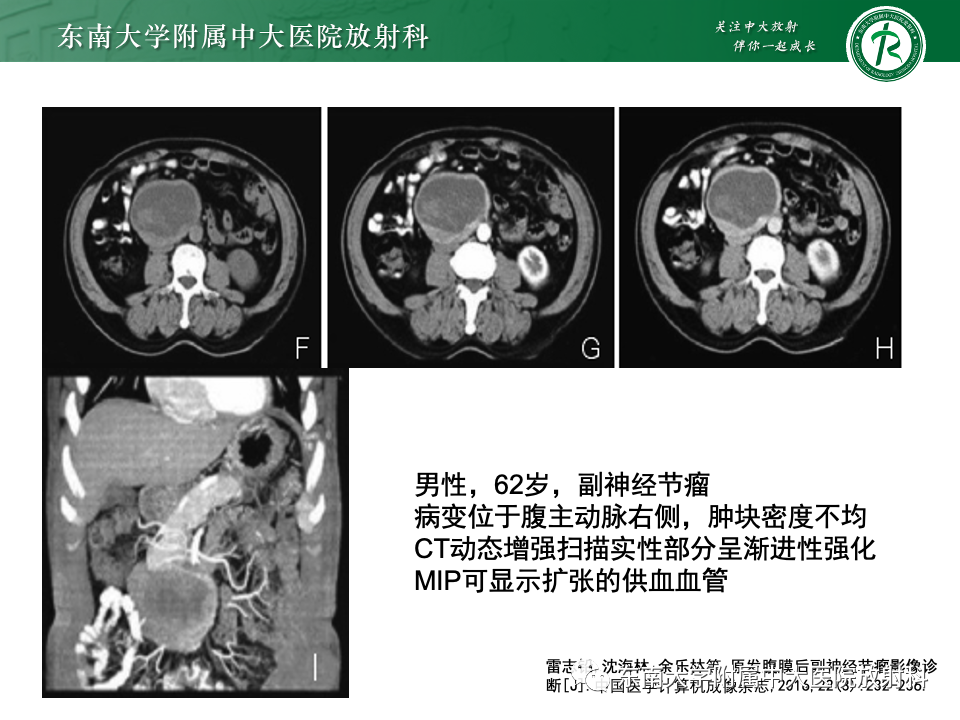 影像PPT - 【PPT】副神经节瘤的影像-31