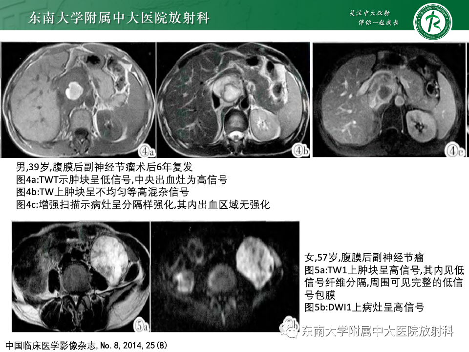 影像PPT - 【PPT】副神经节瘤的影像-30