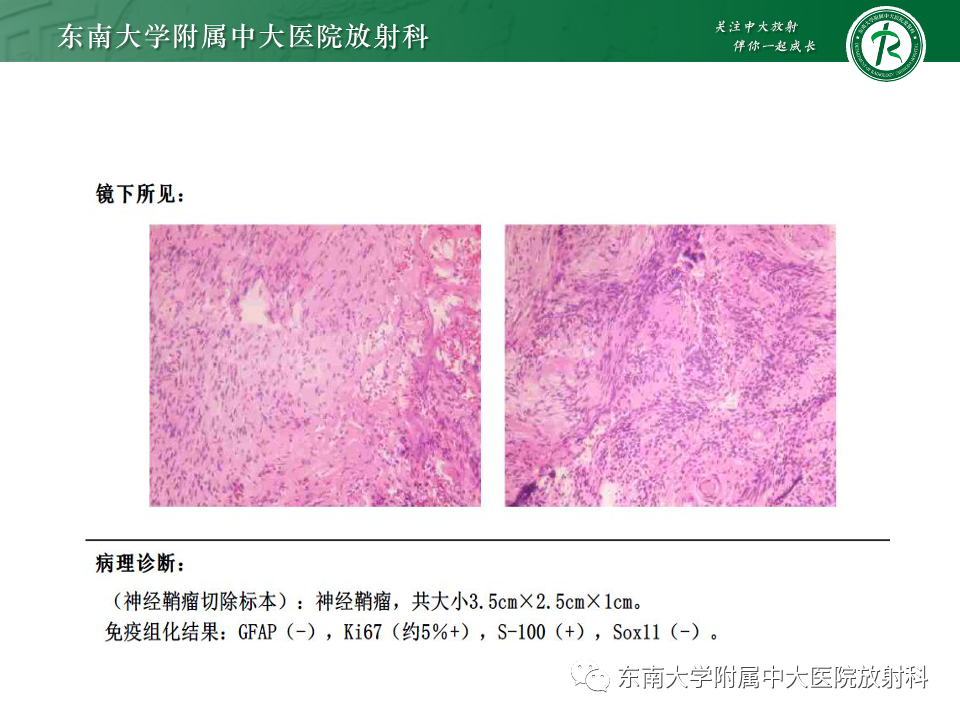 影像PPT - 【PPT】副神经节瘤的影像-42