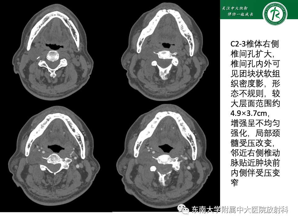 影像PPT - 【PPT】副神经节瘤的影像-41