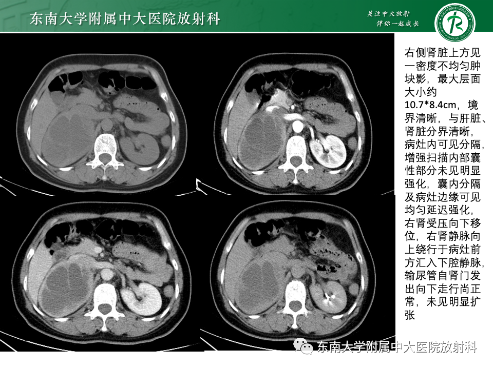 影像PPT - 【PPT】副神经节瘤的影像-37