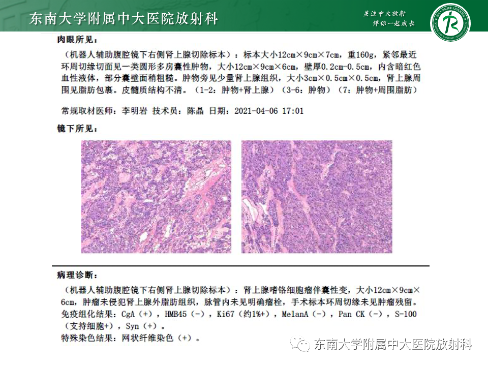 影像PPT - 【PPT】副神经节瘤的影像-38