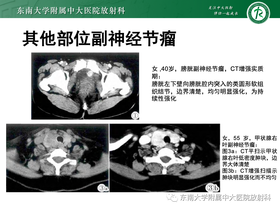 影像PPT - 【PPT】副神经节瘤的影像-46