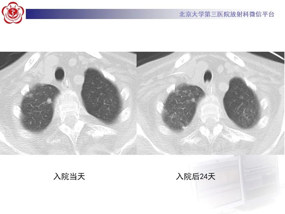 影像PPT - 【PPT】侵袭性念珠菌病肺内播散的影像-5