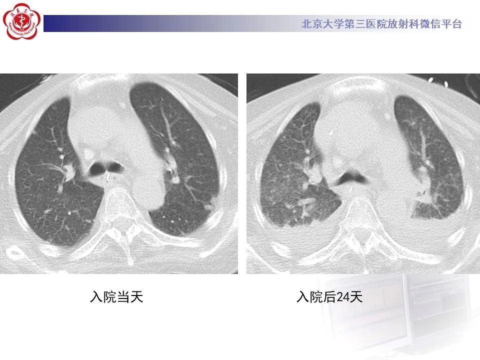 影像PPT - 【PPT】侵袭性念珠菌病肺内播散的影像-6