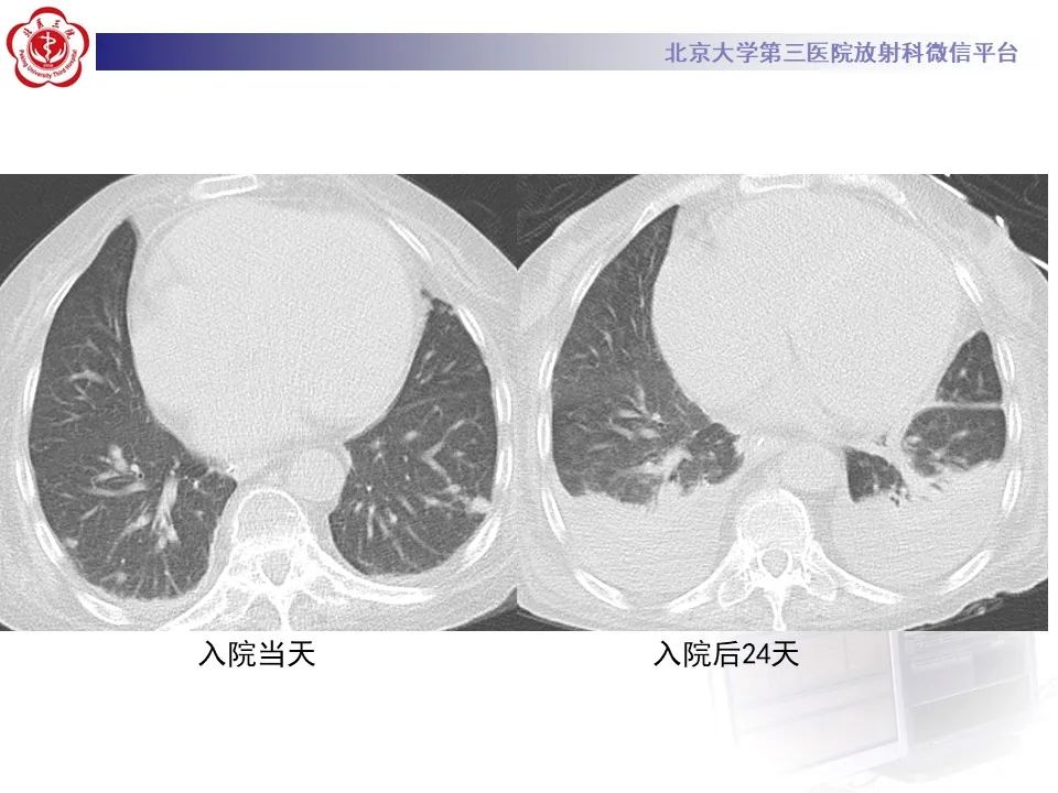 影像PPT - 【PPT】侵袭性念珠菌病肺内播散的影像-8