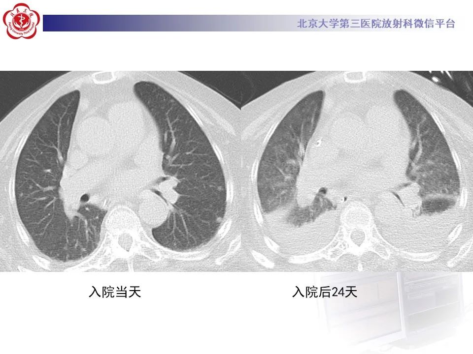 影像PPT - 【PPT】侵袭性念珠菌病肺内播散的影像-7