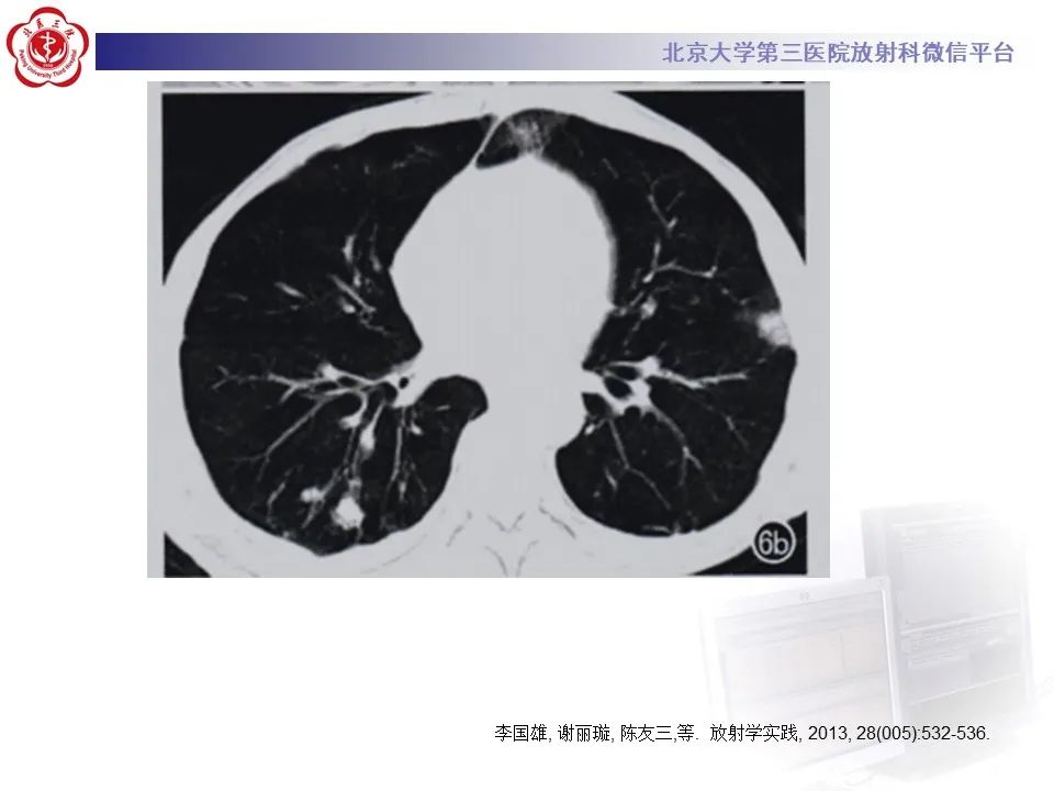影像PPT - 【PPT】侵袭性念珠菌病肺内播散的影像-22