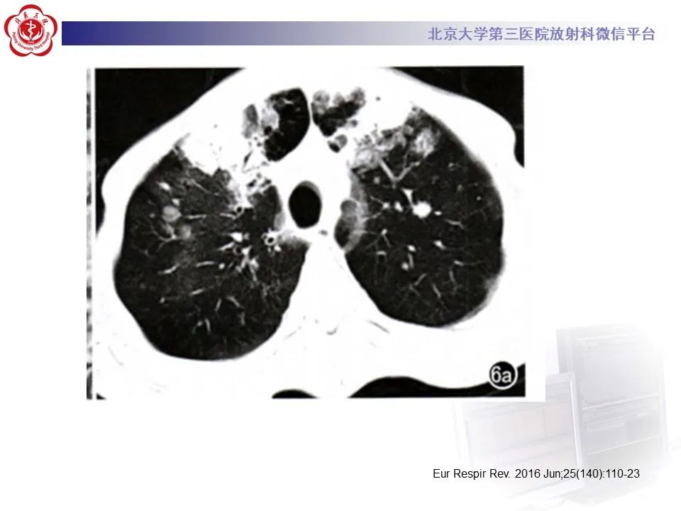 影像PPT - 【PPT】侵袭性念珠菌病肺内播散的影像-23