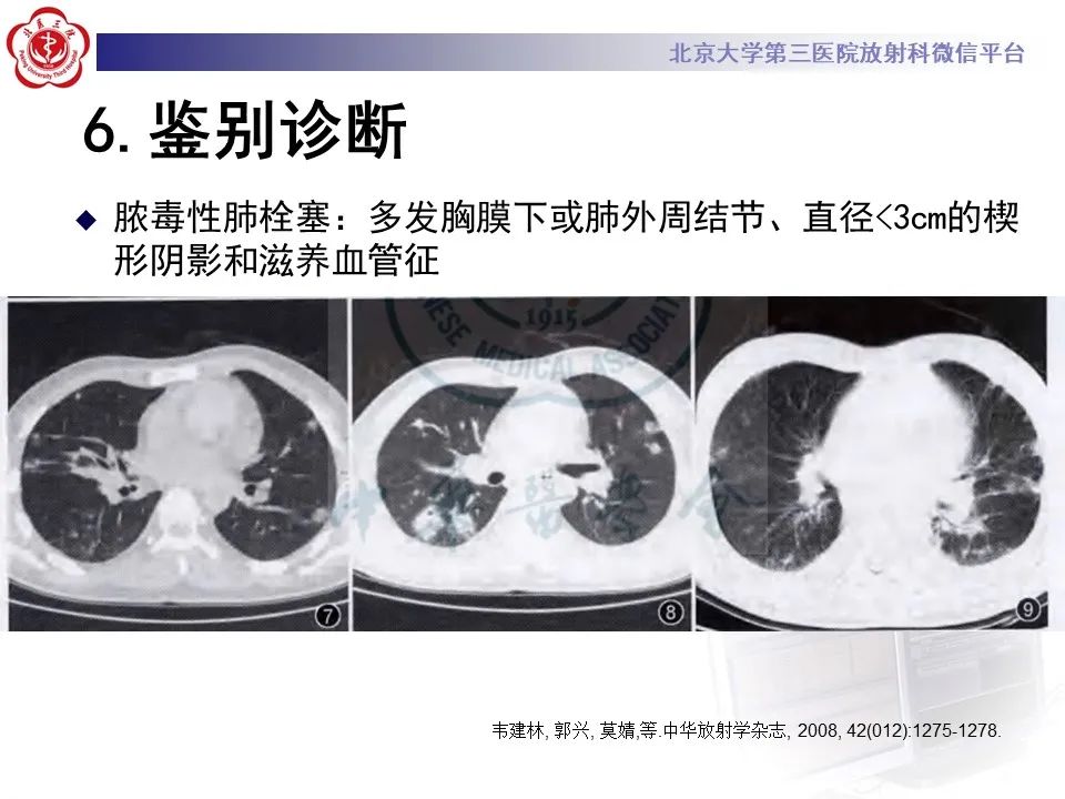 影像PPT - 【PPT】侵袭性念珠菌病肺内播散的影像-26