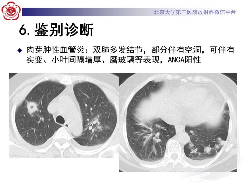 影像PPT - 【PPT】侵袭性念珠菌病肺内播散的影像-28