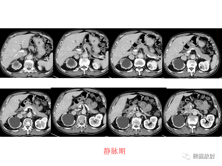 影像PPT - 【病例】腹膜后Castleman病2例CT及MR影像-6