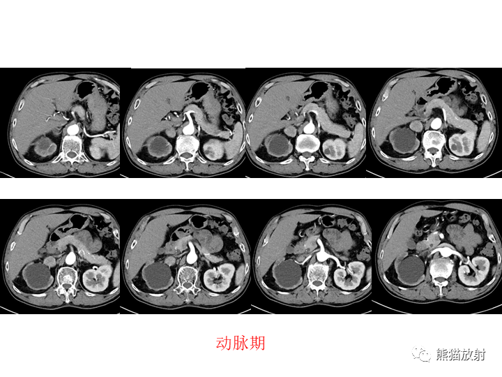 影像PPT - 【病例】腹膜后Castleman病2例CT及MR影像-5