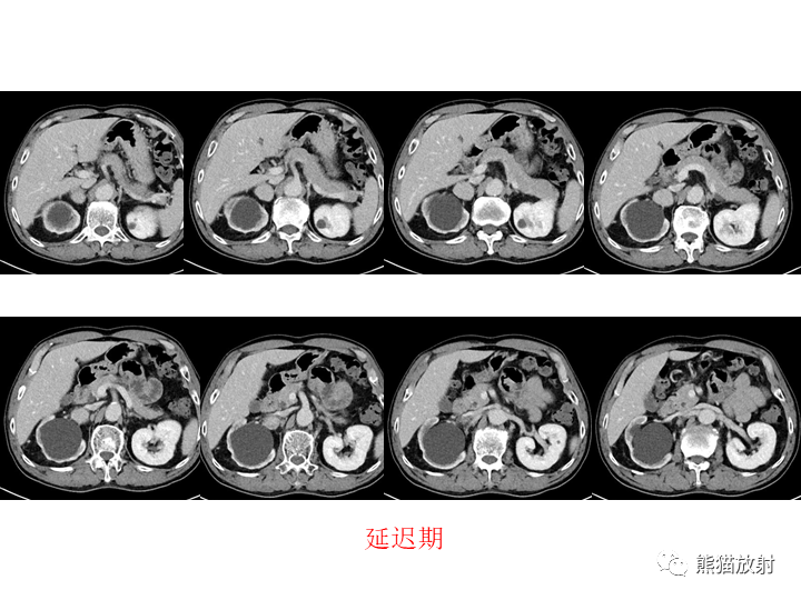 影像PPT - 【病例】腹膜后Castleman病2例CT及MR影像-7