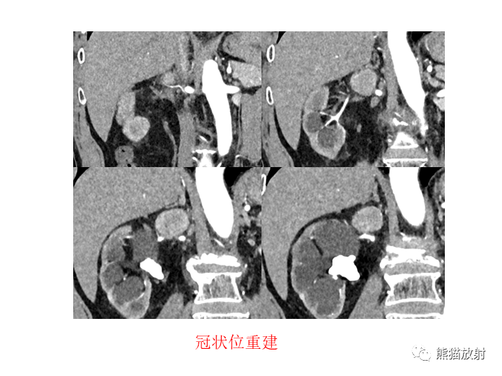 影像PPT - 【病例】腹膜后Castleman病2例CT及MR影像-8